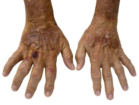 Hand affected by RA